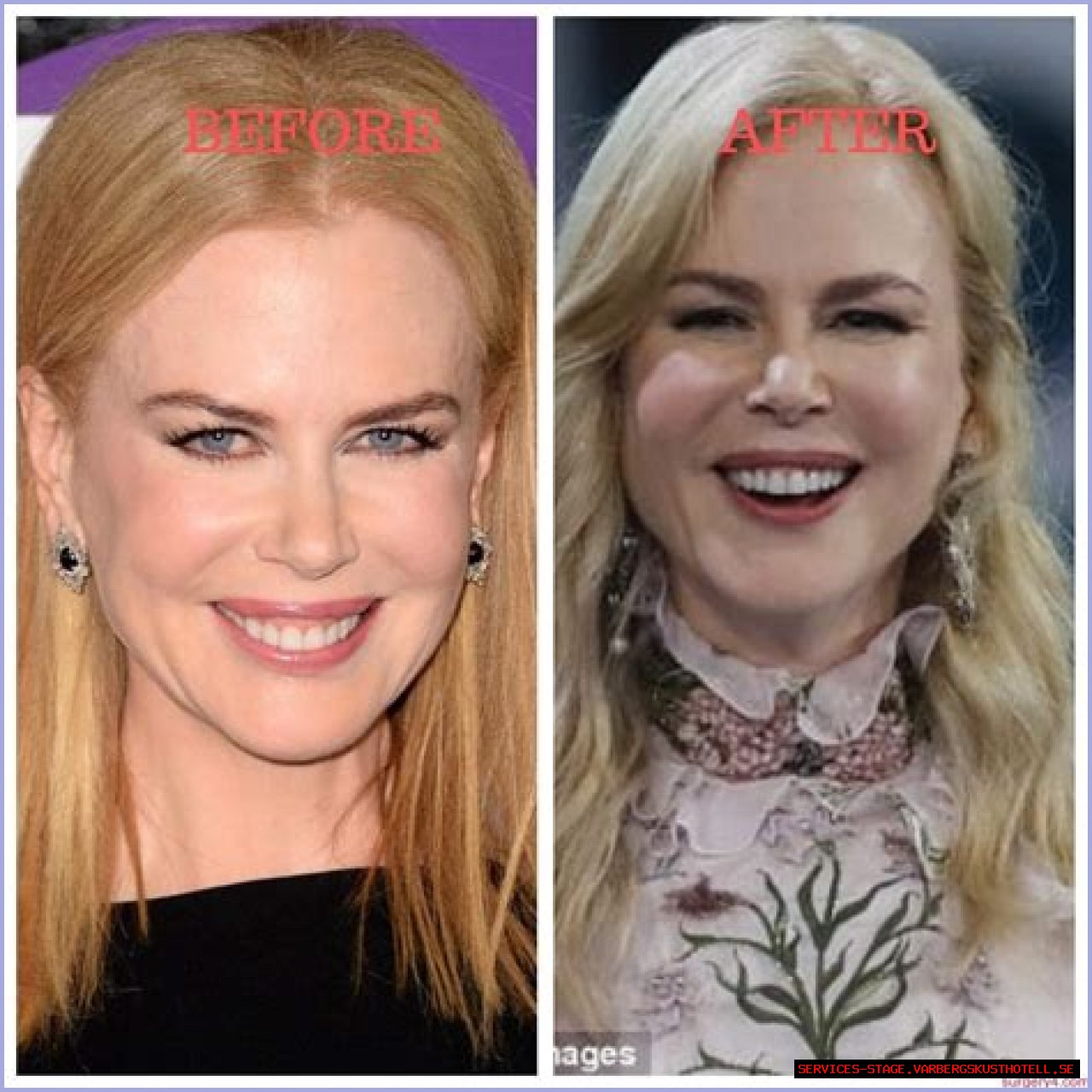 Nicole Kidman's 'Lioness' Plastic Surgery: Uncovering Hidden Truths