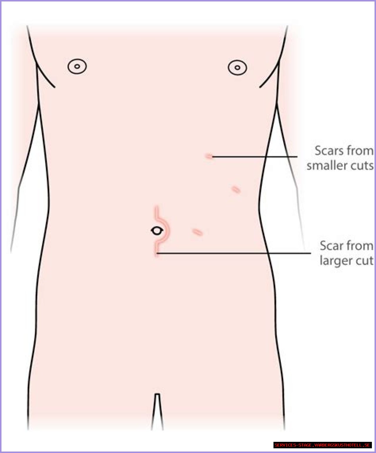 Unveiling The Truth About Kidney Surgery Scars: A Comprehensive Guide